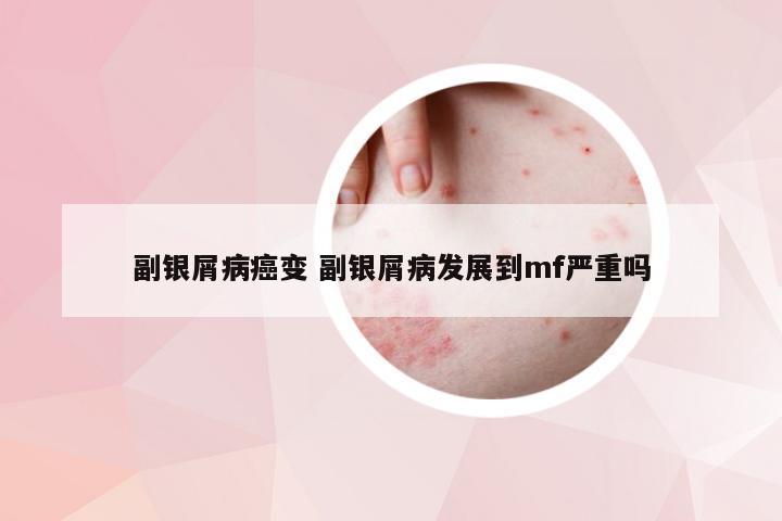 副银屑病癌变 副银屑病发展到mf严重吗