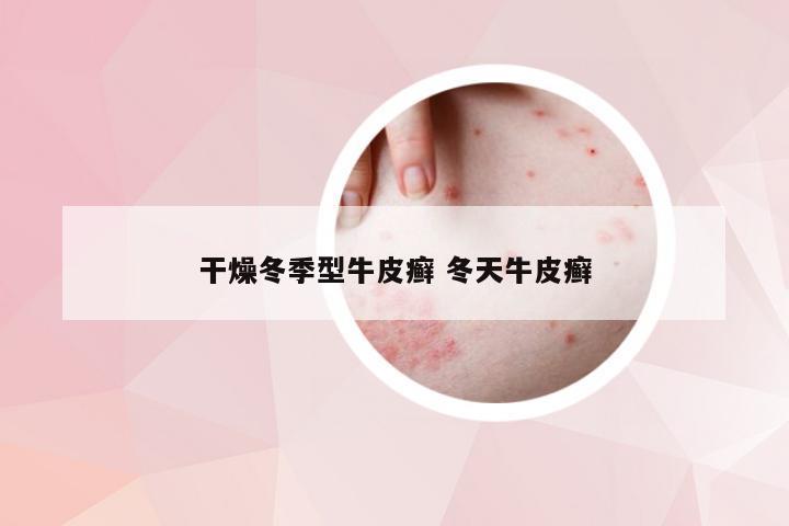 干燥冬季型牛皮癣 冬天牛皮癣