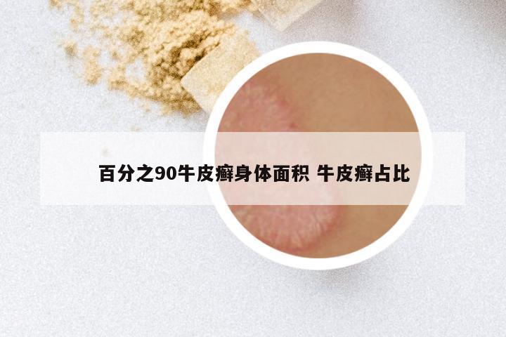 百分之90牛皮癣身体面积 牛皮癣占比