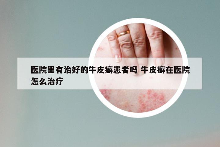 医院里有治好的牛皮癣患者吗 牛皮癣在医院怎么治疗