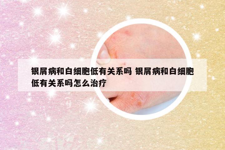 银屑病和白细胞低有关系吗 银屑病和白细胞低有关系吗怎么治疗