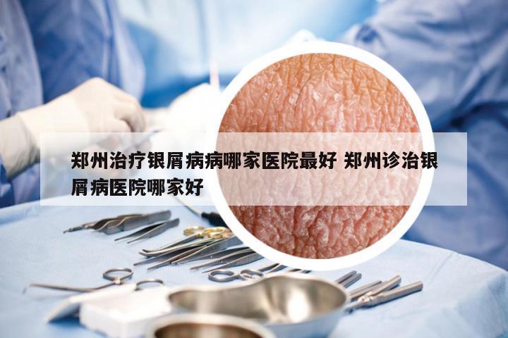 郑州治疗银屑病病哪家医院最好 郑州诊治银屑病医院哪家好