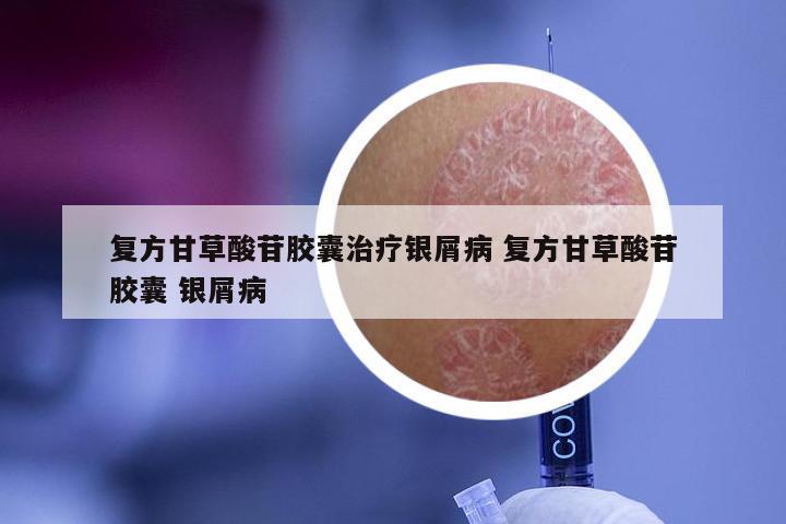 复方甘草酸苷胶囊治疗银屑病 复方甘草酸苷胶囊 银屑病