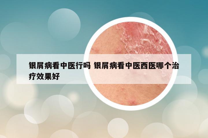银屑病看中医行吗 银屑病看中医西医哪个治疗效果好
