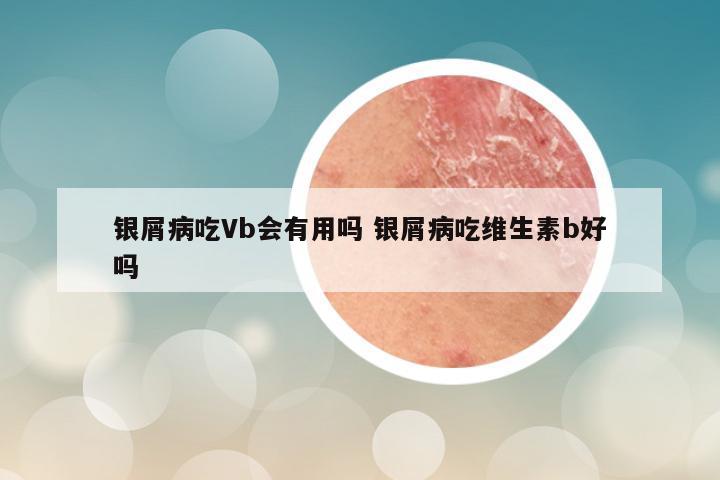 银屑病吃Vb会有用吗 银屑病吃维生素b好吗