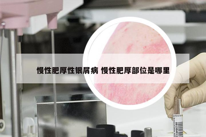 慢性肥厚性银屑病 慢性肥厚部位是哪里