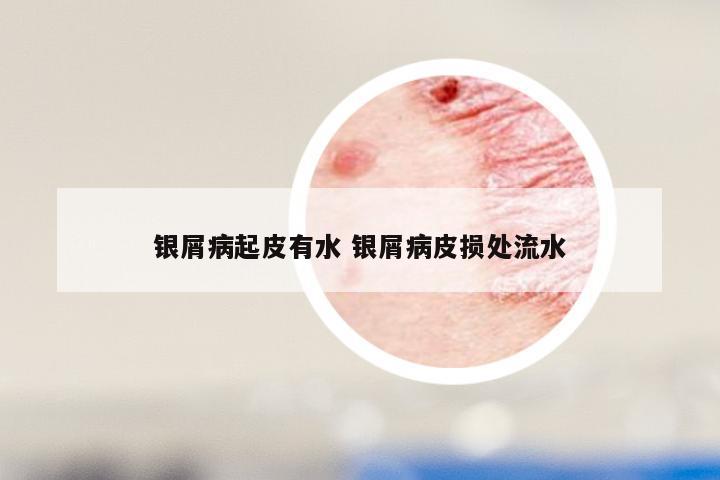 银屑病起皮有水 银屑病皮损处流水