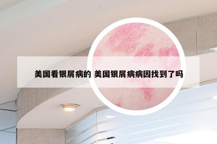 美国看银屑病的 美国银屑病病因找到了吗