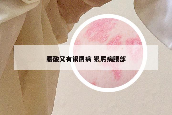 腰酸又有银屑病 银屑病腰部