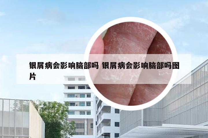 银屑病会影响脑部吗 银屑病会影响脑部吗图片