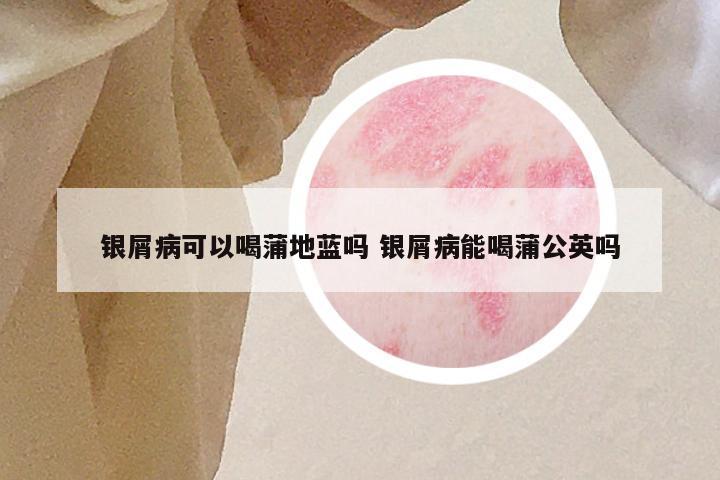 银屑病可以喝蒲地蓝吗 银屑病能喝蒲公英吗