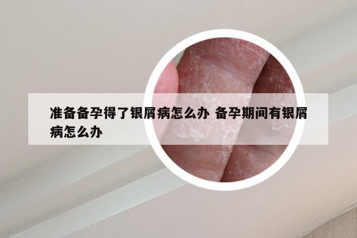 准备备孕得了银屑病怎么办 备孕期间有银屑病怎么办