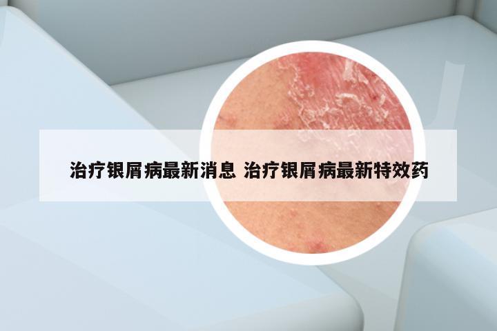 治疗银屑病最新消息 治疗银屑病最新特效药
