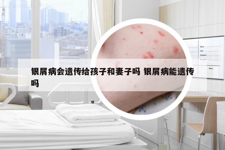 银屑病会遗传给孩子和妻子吗 银屑病能遗传吗