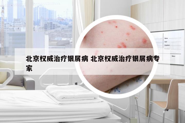 北京权威治疗银屑病 北京权威治疗银屑病专家
