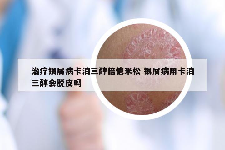 治疗银屑病卡泊三醇倍他米松 银屑病用卡泊三醇会脱皮吗