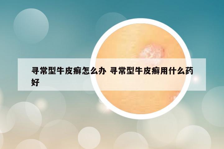 寻常型牛皮癣怎么办 寻常型牛皮癣用什么药好