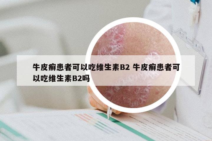 牛皮癣患者可以吃维生素B2 牛皮癣患者可以吃维生素B2吗
