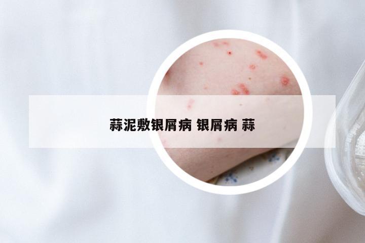 蒜泥敷银屑病 银屑病 蒜