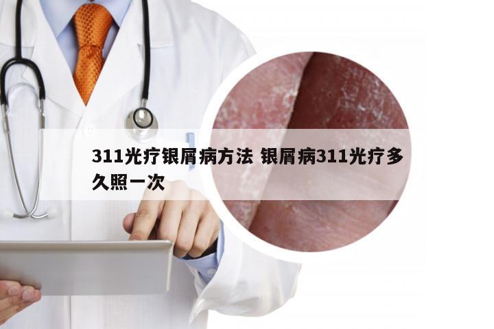 311光疗银屑病方法 银屑病311光疗多久照一次