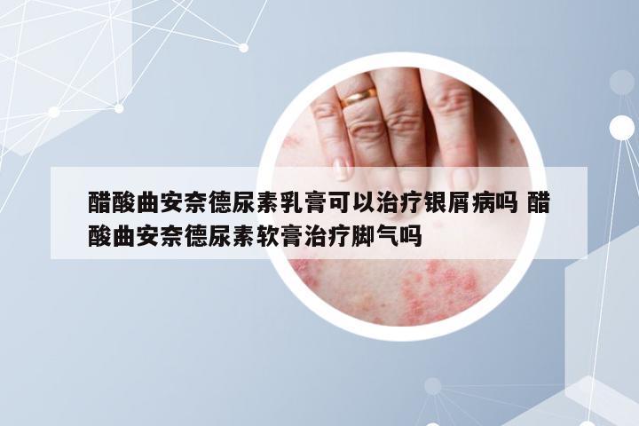 醋酸曲安奈德尿素乳膏可以治疗银屑病吗 醋酸曲安奈德尿素软膏治疗脚气吗