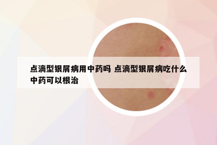 点滴型银屑病用中药吗 点滴型银屑病吃什么中药可以根治