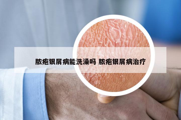 脓疱银屑病能洗澡吗 脓疱银屑病治疗