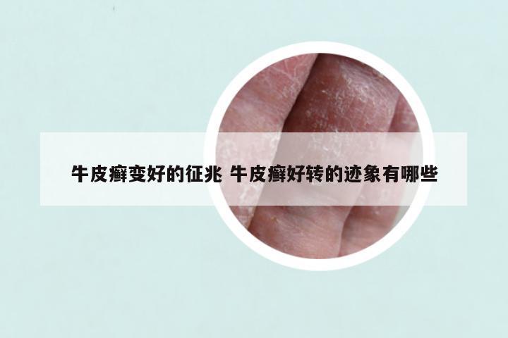 牛皮癣变好的征兆 牛皮癣好转的迹象有哪些