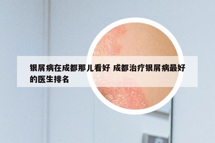 银屑病在成都那儿看好 成都治疗银屑病最好的医生排名