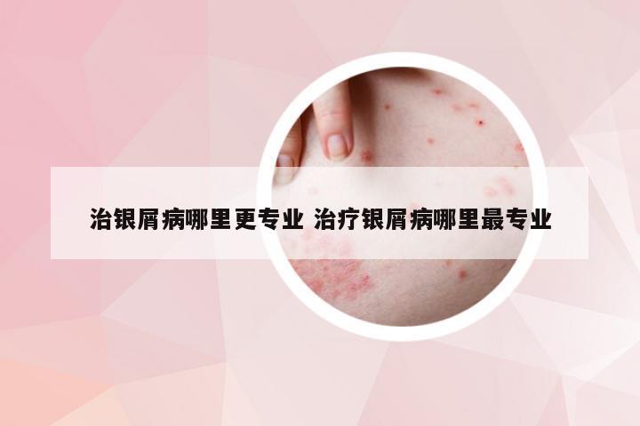 治银屑病哪里更专业 治疗银屑病哪里最专业