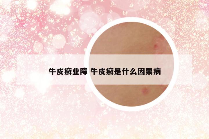 牛皮癣业障 牛皮癣是什么因果病