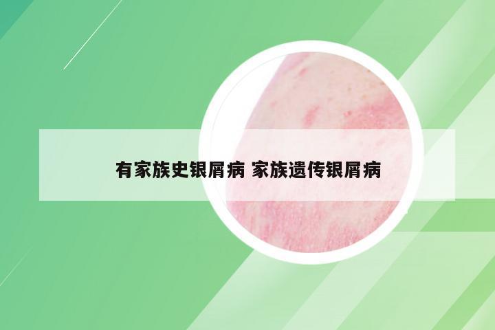 有家族史银屑病 家族遗传银屑病
