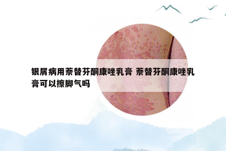银屑病用萘替芬酮康唑乳膏 萘替芬酮康唑乳膏可以擦脚气吗
