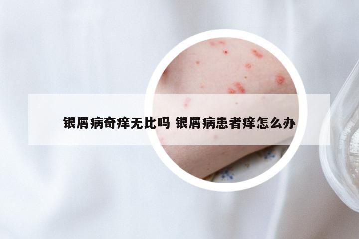 银屑病奇痒无比吗 银屑病患者痒怎么办