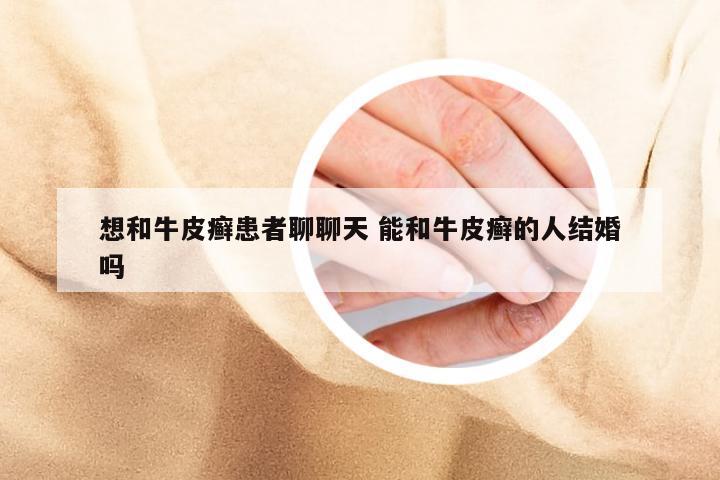 想和牛皮癣患者聊聊天 能和牛皮癣的人结婚吗