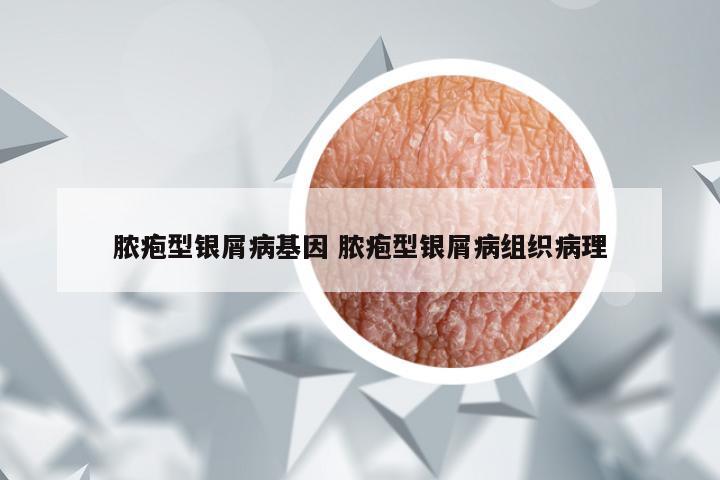 脓疱型银屑病基因 脓疱型银屑病组织病理