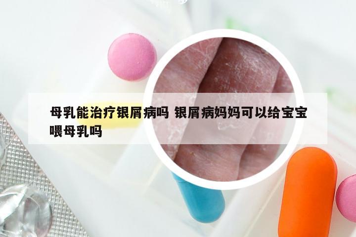 母乳能治疗银屑病吗 银屑病妈妈可以给宝宝喂母乳吗