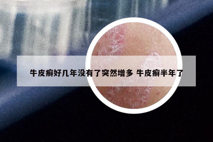 牛皮癣好几年没有了突然增多 牛皮癣半年了