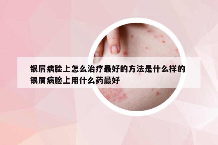 银屑病脸上怎么治疗最好的方法是什么样的 银屑病脸上用什么药最好