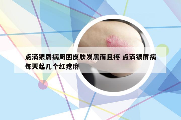 点滴银屑病周围皮肤发黑而且疼 点滴银屑病每天起几个红疙瘩