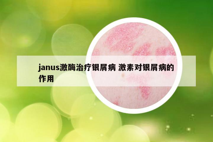 janus激酶治疗银屑病 激素对银屑病的作用