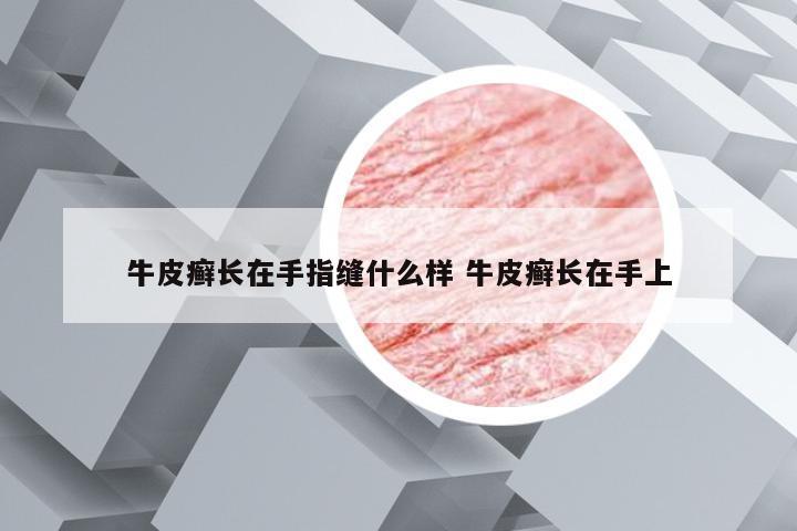 牛皮癣长在手指缝什么样 牛皮癣长在手上