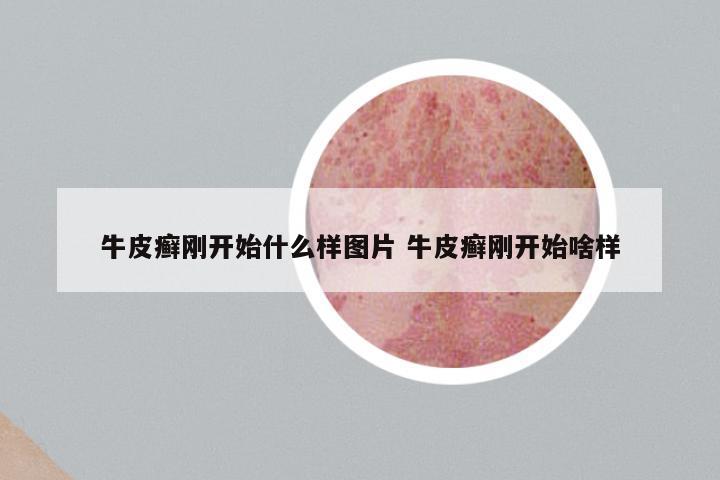 牛皮癣刚开始什么样图片 牛皮癣刚开始啥样