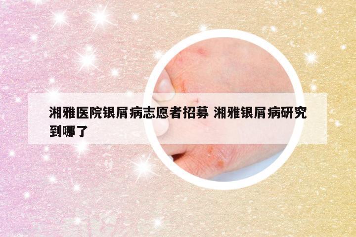 湘雅医院银屑病志愿者招募 湘雅银屑病研究到哪了