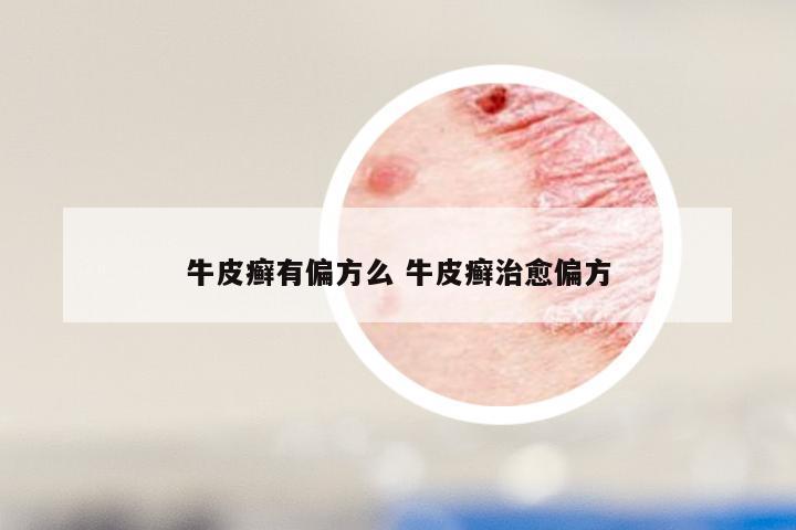 牛皮癣有偏方么 牛皮癣治愈偏方