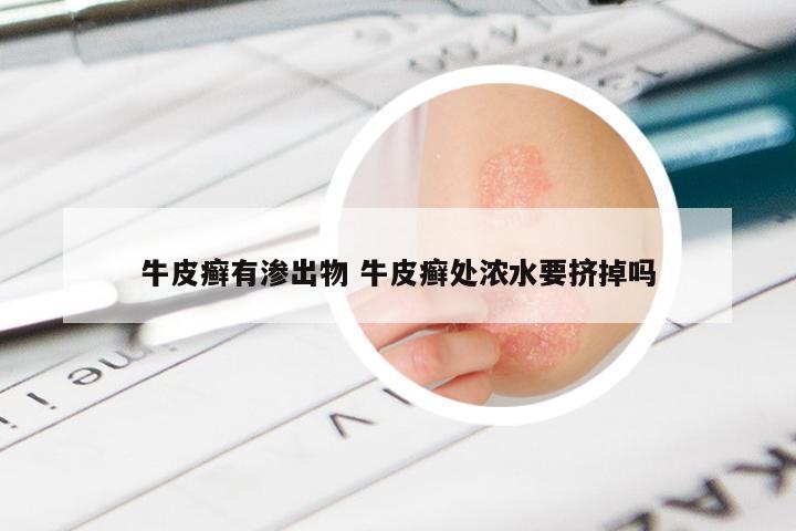 牛皮癣有渗出物 牛皮癣处浓水要挤掉吗