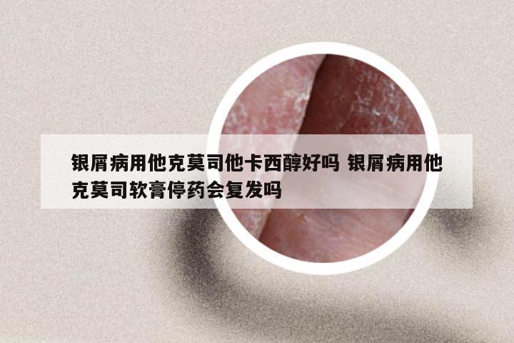 银屑病用他克莫司他卡西醇好吗 银屑病用他克莫司软膏停药会复发吗