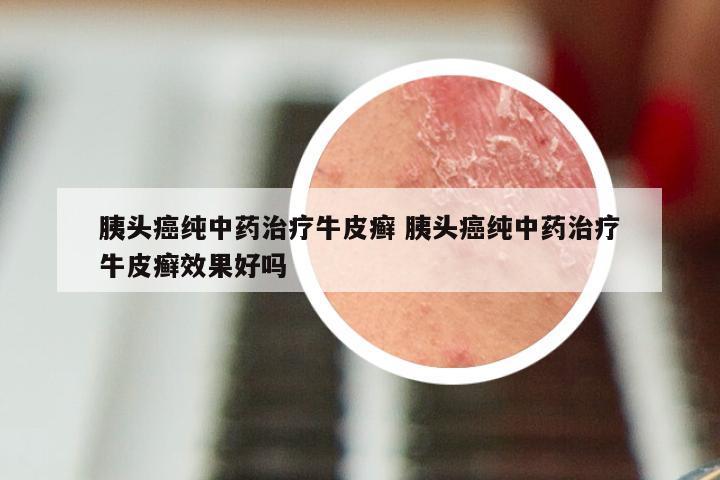 胰头癌纯中药治疗牛皮癣 胰头癌纯中药治疗牛皮癣效果好吗