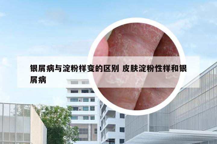 银屑病与淀粉样变的区别 皮肤淀粉性样和银屑病