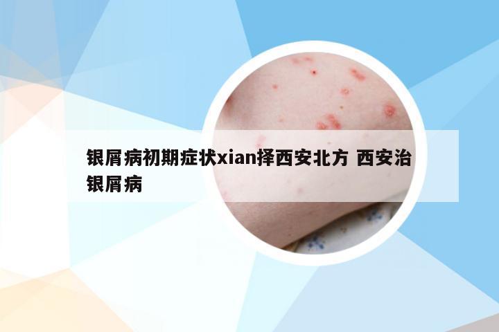银屑病初期症状xian择西安北方 西安治银屑病